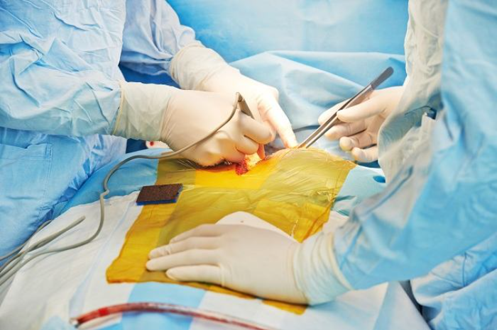 Tambalan Jantung: Terobosan Medis untuk Atasi Krisis Donor Organ