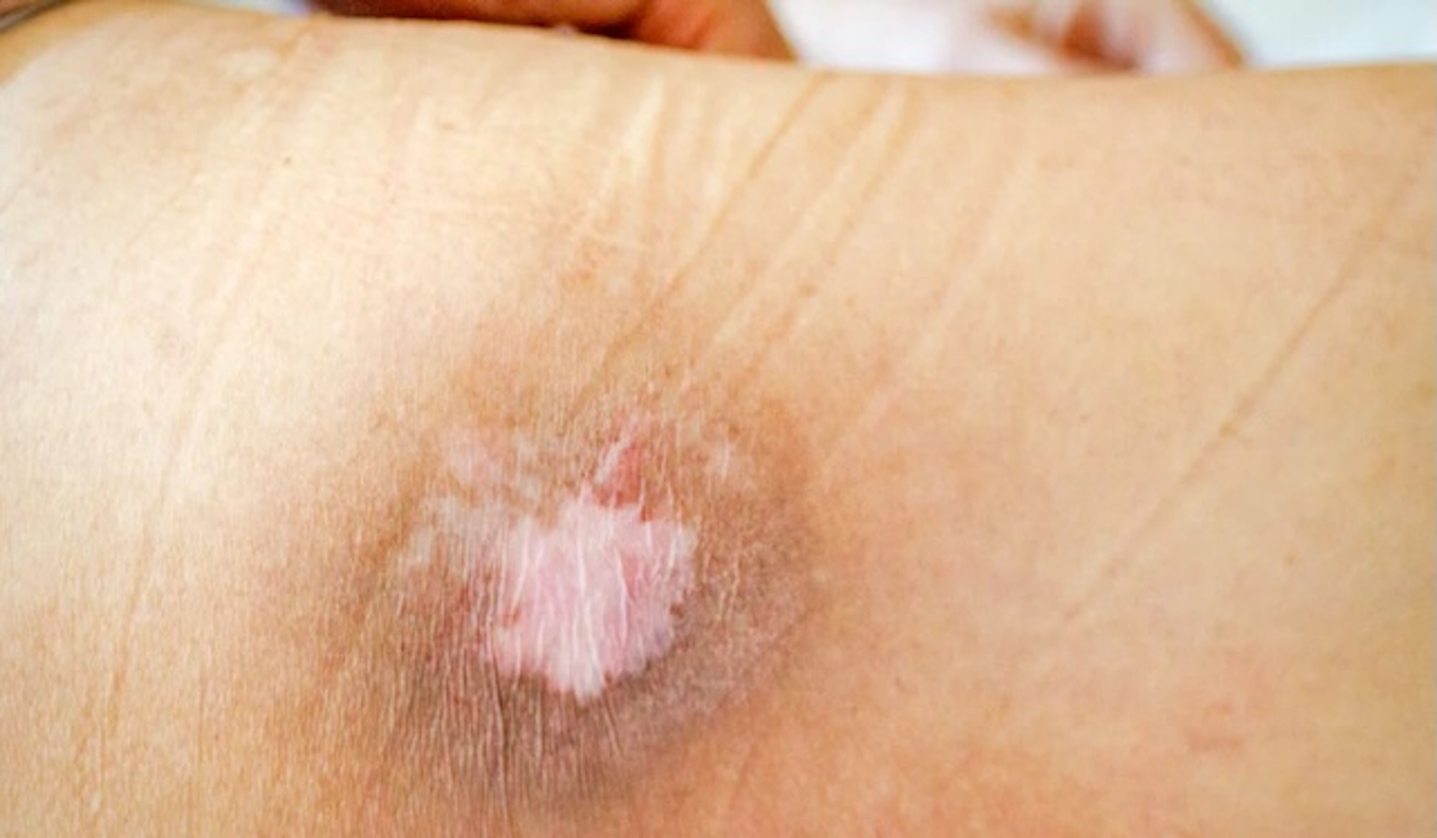 Waspada! Bed Sores Bisa Berujung Infeksi Serius
