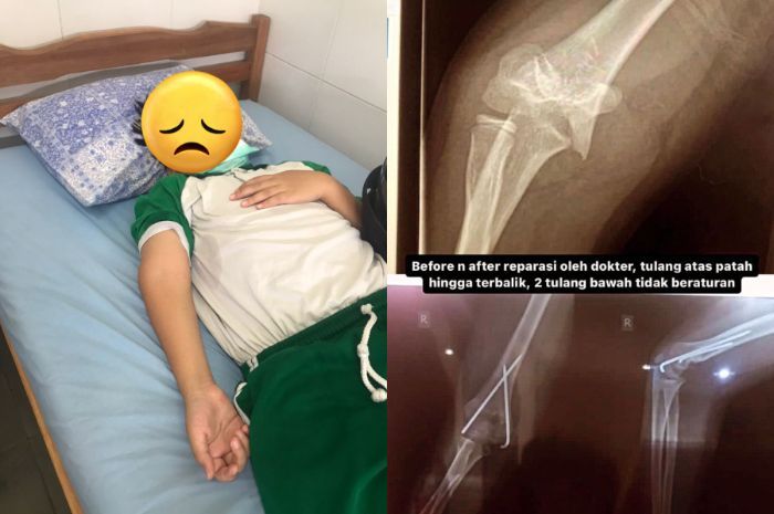 Terjadi Lagi Kasus Bully di Sekolah, Tangan Korban Patah hingga Diintimidasi Guru dan Orang Tua Pelaku
