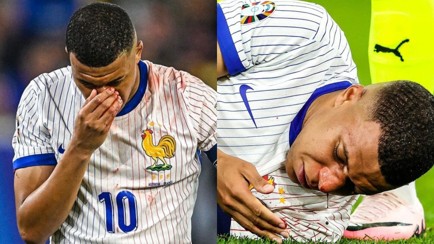 Mbappe Alami Cedera Patah Tulang Hidung Saat Hadapi Austria di Euro 2024